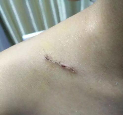 乳泉癌手术后可以吃角瓜,角瓜助力康复之旅